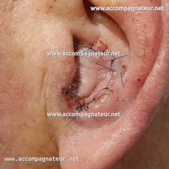 Carcinome basocellulaire dans la conque de l'oreille après opération Carcinome basocellulaire dans la conque de l'oreille après opération