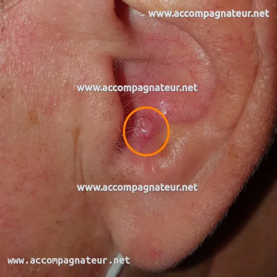 Carcinome basocellulaire dans la conque de l'oreille Carcinome basocellulaire dans la conque de l'oreille