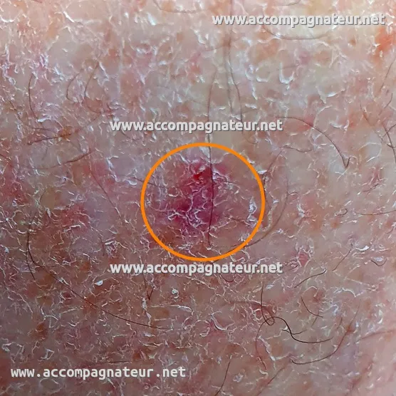 Carcinome basocellulaire au mollet Carcinome basocellulaire au mollet