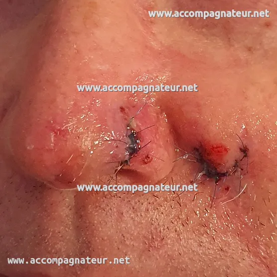 Site du carcinome basocellulaire au nez après la seconde opération (section du lambeau) Site du carcinome basocellulaire au nez après seconde opération