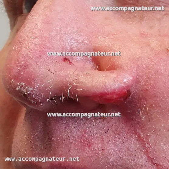 Site du carcinome basocellulaire au nez après la première opération (greffe du lambeau) Site du carcinome basocellulaire au nez après la première opération