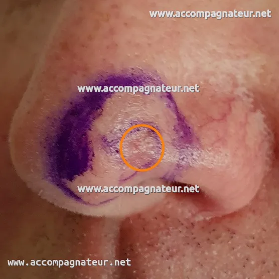 Carcinome basocellulaire au nez Carcinome basocellulaire au nez
