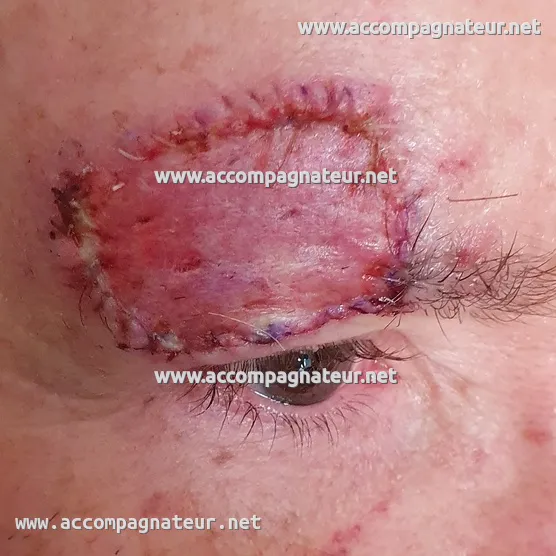 Site du mélanome malin au sourcil après l'opération Site du mélanome malin au sourcil après opération